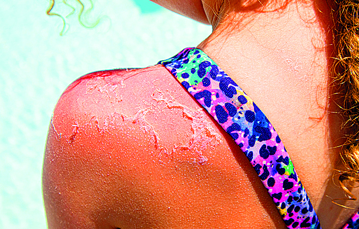 Detailní pohled na dětské rameno s těžkým spálením od slunce. Zarudlá kůže s odumřelou kůží, která se odlupuje venku u bazénu.