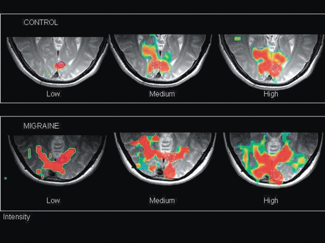 Porovnání migrény s klidovým stavem na magnetické rezonanci.
