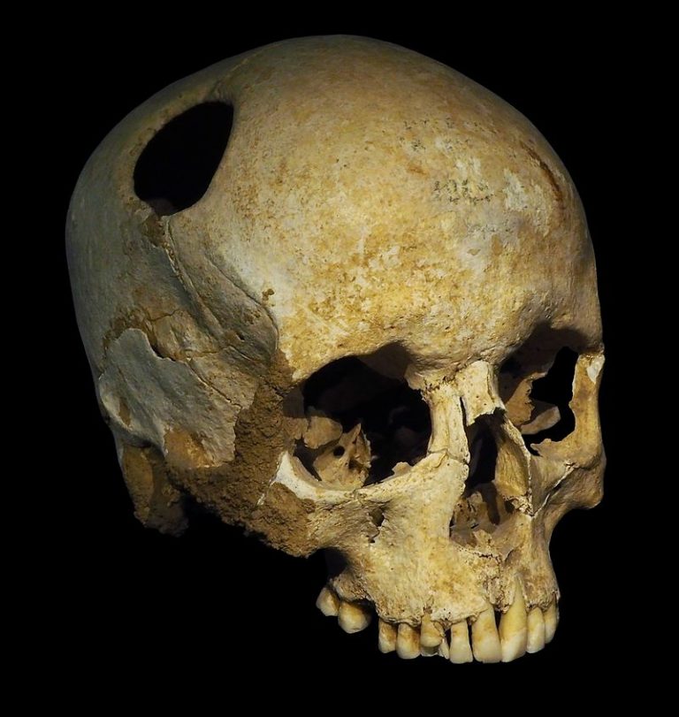 Trepanovaná lebka z období neolitu.