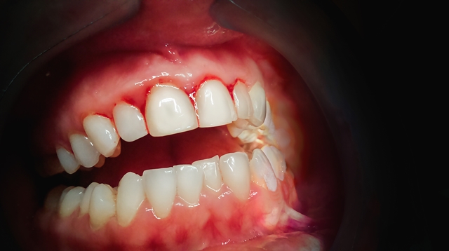 Zánět dásní Způsobuje jej plak ve žlábku kolem zubu a krčku. Bývá plný bakterií, a když s nimi náš organismus začne bojovat, dané místo se více prokrví a oteče.