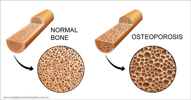 Osteoporóza se projevuje i ztrátou výšky.