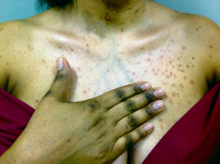 Za přípravky pro bělení kůže utratí Indové ročně více než za Coca-colu. Vedlejší účinky přitom zahrnují fleky, vřídky, vyrážky, jizvy, v extrémních případech i otravu a smrt.