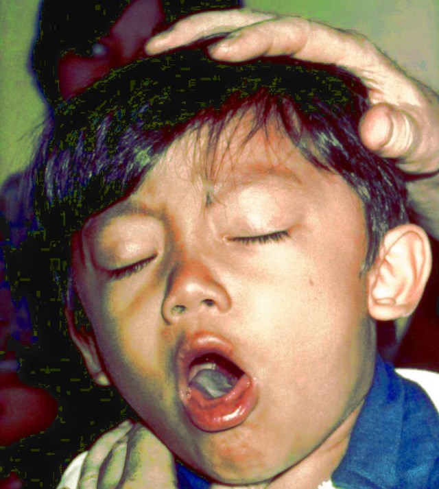 Černý kašel postihuje hlavně děti v rozvojových zemích.