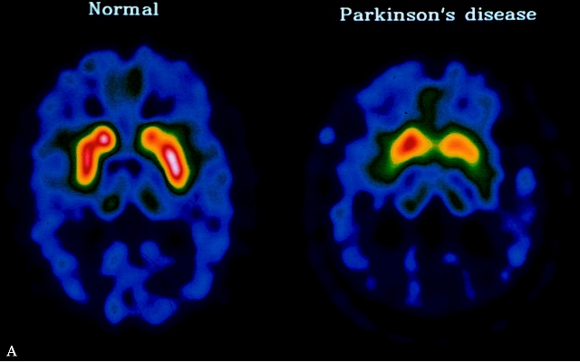 Stejně jako u Parkinsonovy choroby se objevuje hyperaktivita zrakových nervů.