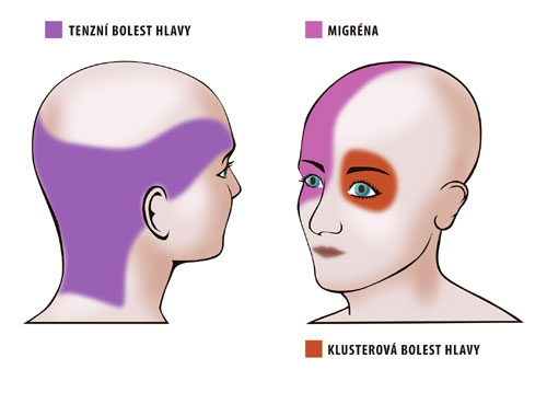 Znázornění různých typů bolesti hlavy.