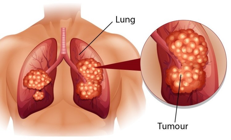 Bez včasného zásahu lékařů se nádorové buňky uvnitř plic množí velice rychle.