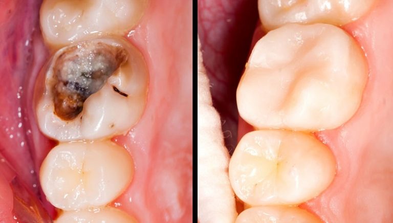 Rozdíl mezi zdravým a zkaženým zubem je patrný na první pohled.