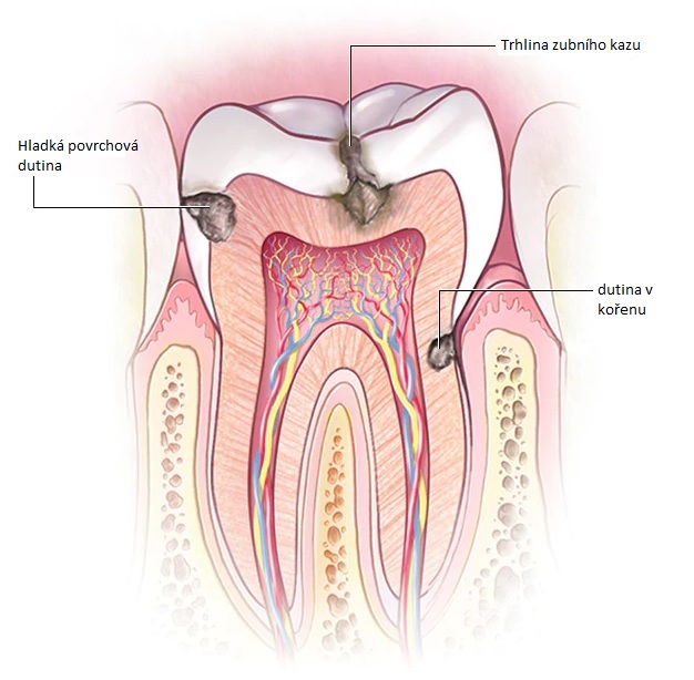 Zubní kaz se může utvořit v jakékoli části zubu.