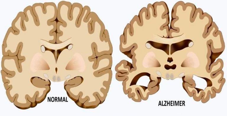 Grafické znázornění zdravého a nemocného mozku.