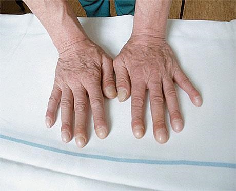 Paličkové prsty a nehty ve tvaru hodinových sklíček jsou jedním z příznaků IPF.