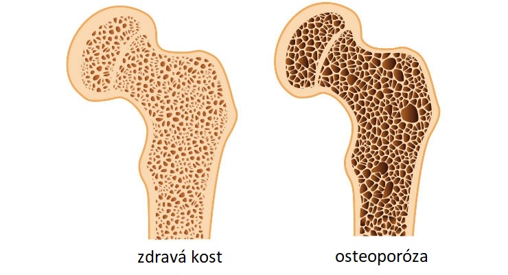 Tiché, nenápadně se rozvíjející onemocnění je též označováno jako řídnutí kostí a v ČR postihuje až 8 % obyvatel.
