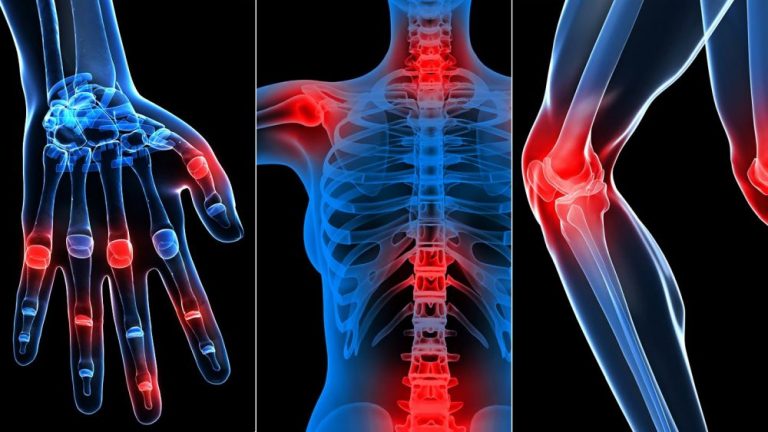 Imunitní systém při revmatoidní artritidě napadá klouby, nezvratně je poškozuje a vyvolává v nich chronickou bolest.
