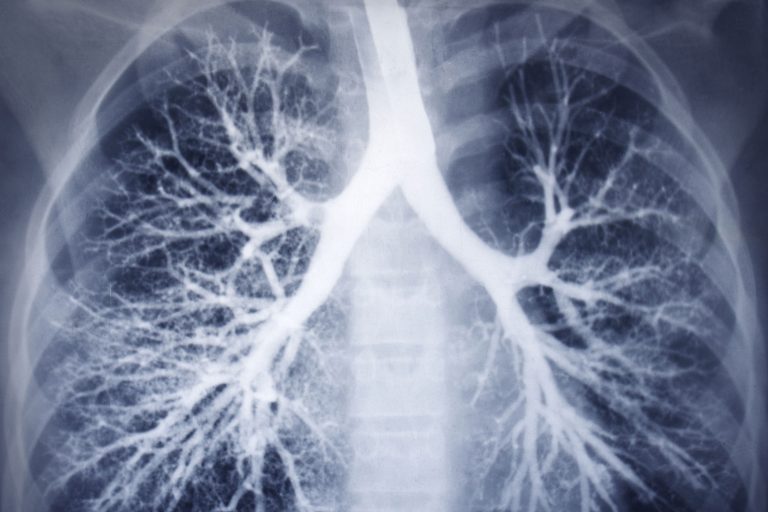 V důsledku plicní fibrózy se zvyšuje riziko plicní embolie.