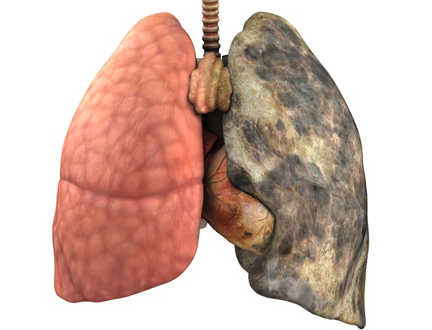 Karcinom plic patří k nejčastějším onkologickým příčinám smrti u mužů mezi 65–69 lety. Ročně na něj zemře 1,3 milionu mužů a žen.