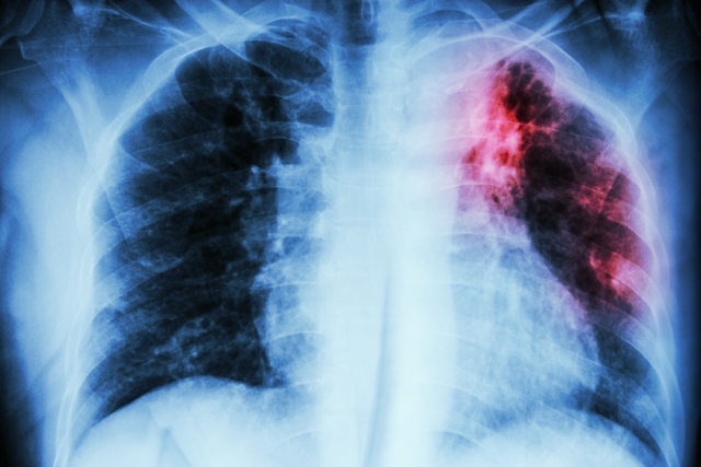 Pouze u jednoho z deseti nemocných se projeví aktivní tuberkulóza. Pokud se tato forma neléčí, polovina případů končí smrtí.