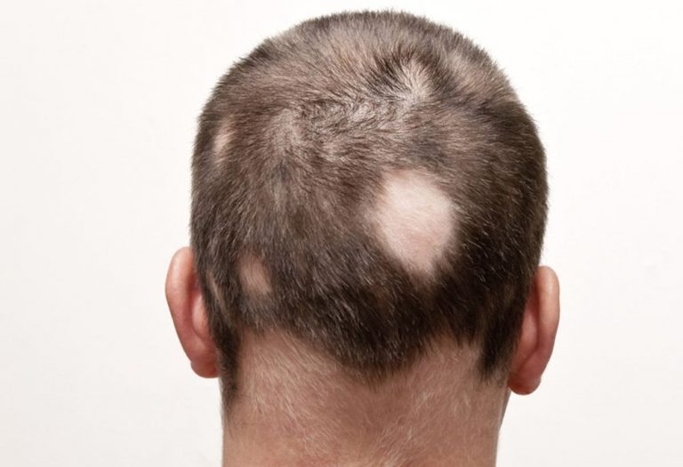 Přední český dermatolog upozorňuje, že lze rozlišit několik typů alopecie, nejčastější formou je mužská plešatost.