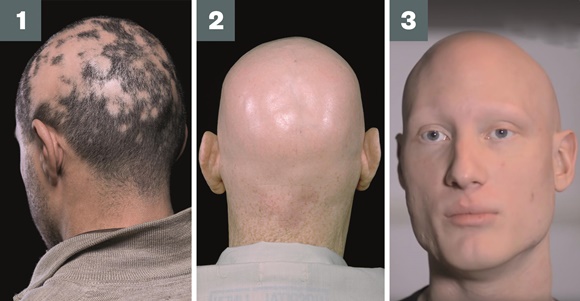Vypadávání vlasů postihuje téměř polovinu mužů nad 40 let.