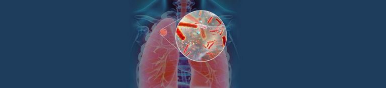 Latentní tuberkulózní infekce nemá typické projevy, na rentgenu se neukazuje, a přitom pacienta přímo ohrožuje na životě.