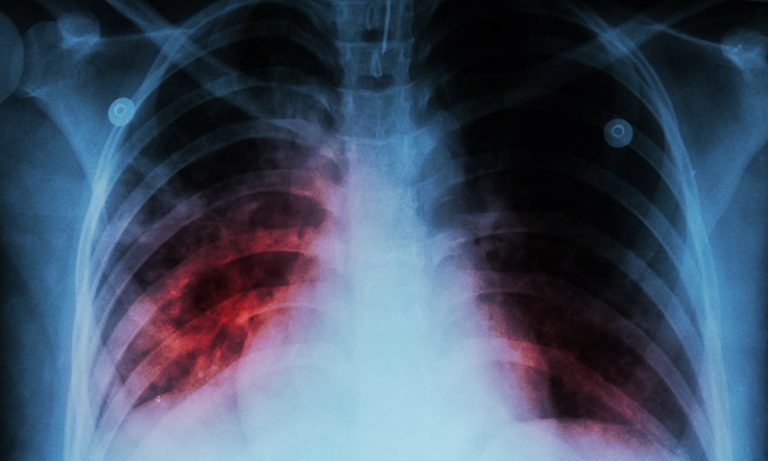 Plicní lékaři před latentní formou infekce varují a chtějí registr.