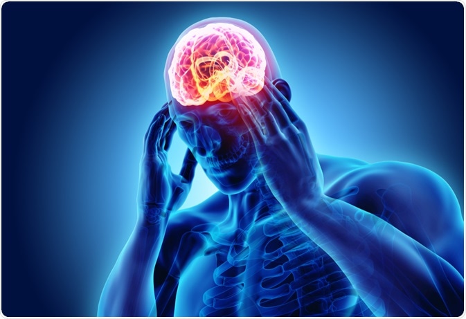 Samotná aura předchází vlastní migrenické bolesti hlavy a běžně se může projevovat dočasnou poruchou zraku a zorného pole, jako jsou záblesky a vidění vlnovek nebo drobných předmětů.
