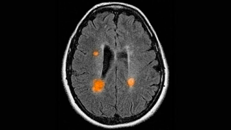 Roztroušená skleróza ovlivňuje schopnost nervových buněk (neuronů) v mozku a míše spolu vzájemně komunikovat.