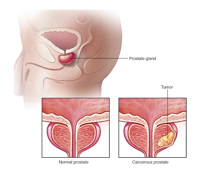 Nádorové onemocnění, rakovina prostaty, nazývané též karcinom prostaty, postihuje nejčastěji muže kolem 70. roku života a výš.