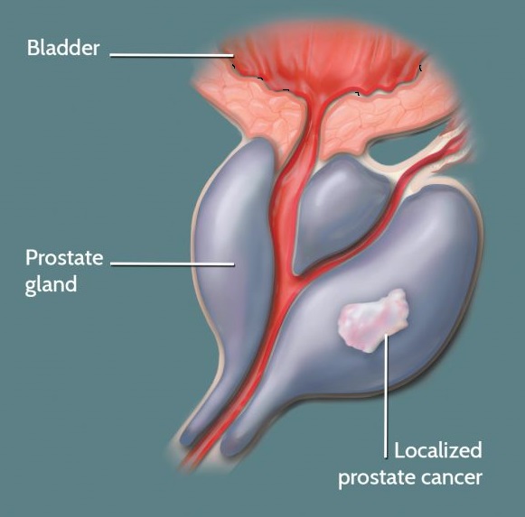 V první fázi je rakovina prostaty asymptomatická, tedy bez příznaků, a je tak většinou odhalena zcela náhodou. Paradoxně uzdravení závisí na včasném odhalení a započetí správné léčby.