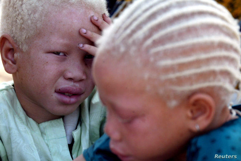 U albínů je větší riziko vzniku kožních nádorů, jejich kůže má sklon k rychlejšímu stárnutí.