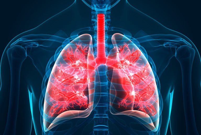 Projevy IPF lékaři často zaměňují za chronickou obstrukční plicní nemoc, zápal plic či srdeční selhání. Bez správné léčby přitom IPF obvykle zabíjí do 5 let.