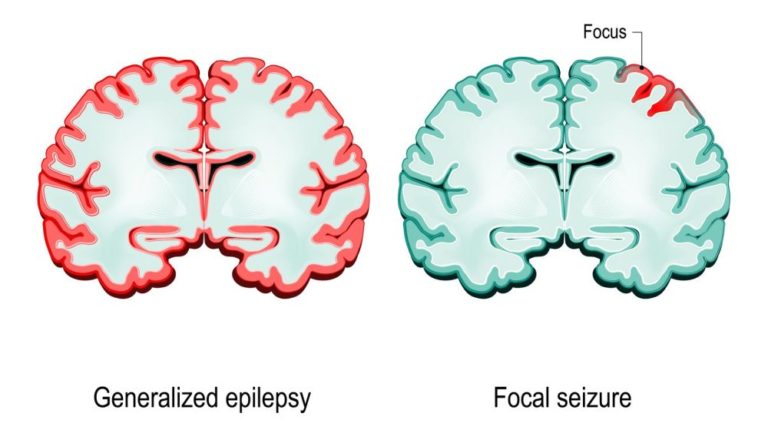 Epilepsie je jedním z nejčastějších chronických neurologických onemocnění, vyskytuje se celosvětově, postihuje ženy i muže, jedince všech věkových kategorií i etnik.