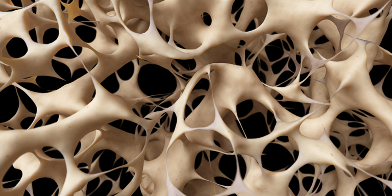 Osteoporóza postihuje až 10 % populace, přičemž léčeno je pouhých 10–20 % případů. Její výskyt postupně roste.
