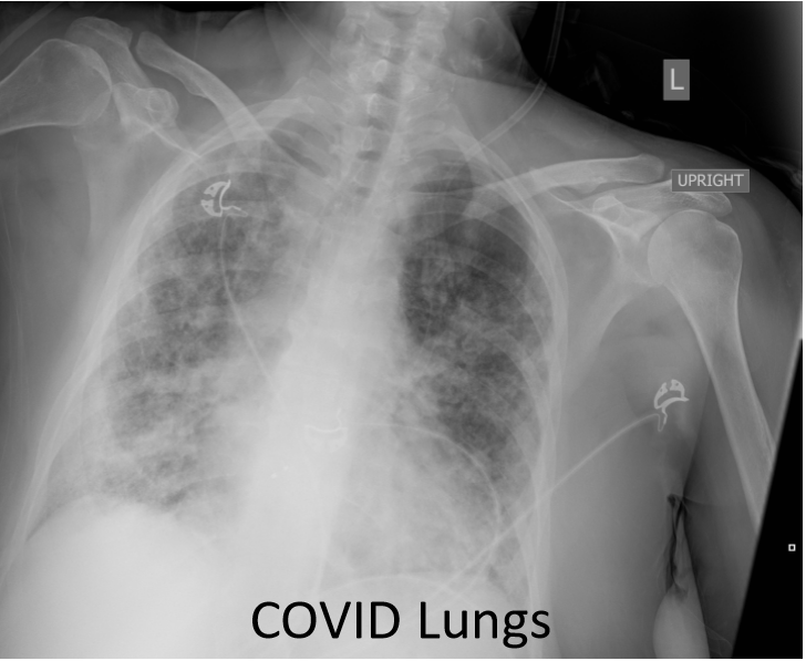 Zkoumání plicních lékařů ve FN Olomouc ukázalo pozánětlivé změny jen u cca 8 % z 80 sledovaných pacientů (a tyto změny byly ve většině případů nevýznamné) a snížení plicních funkcí u přibližně 4 %.