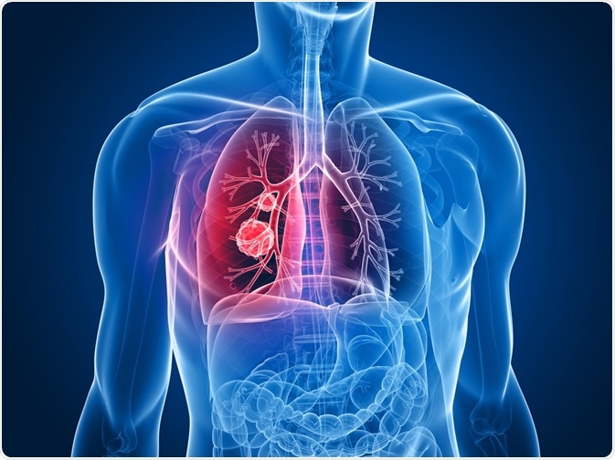 Rakovina plic představuje nejčastější typ nádorového onemocnění plic. Jedná se o nádory, které se objeví na plicích a průduškách a které jsou většinou zhoubné.