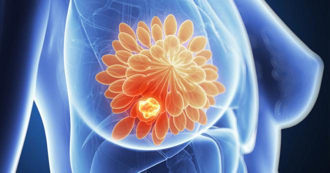Rakovina prsu je nejčastější formou rakoviny u žen, její výskyt má stoupající tendenci, úmrtnost na ni naštěstí stagnuje.