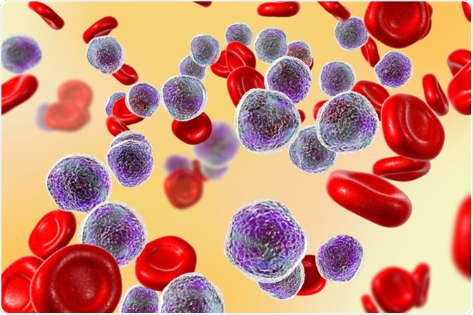 Leukémii lze zjednodušeně chápat jako rakovinu krve.