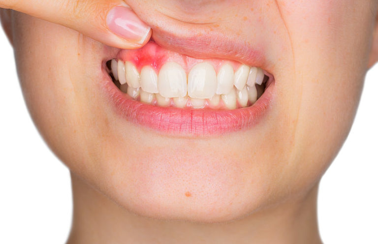 Paradentóza je velkým strašákem zubů, ale i jejich majitelů.