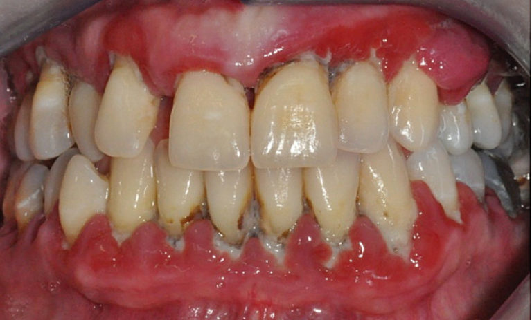 Jde o zánětlivé onemocnění dásní i okolního aparátu, na kterém jsou zuby zavěšeny.