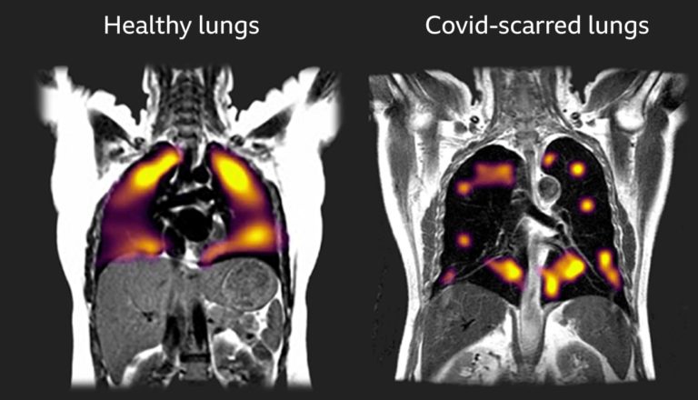 To, co covid-19 v plicích provádí, se vzdáleně podobá působení závažných forem chřipky nebo virového onemocnění SARS, které zde bylo v minulosti.