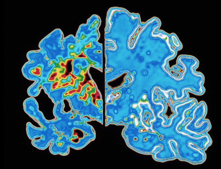 Alzheimerova choroba stojí za 50–60 % případů demence, dalšími typy demence jsou například vaskulární demence, demence s Lewyho tělísky a frontotemporální demence.