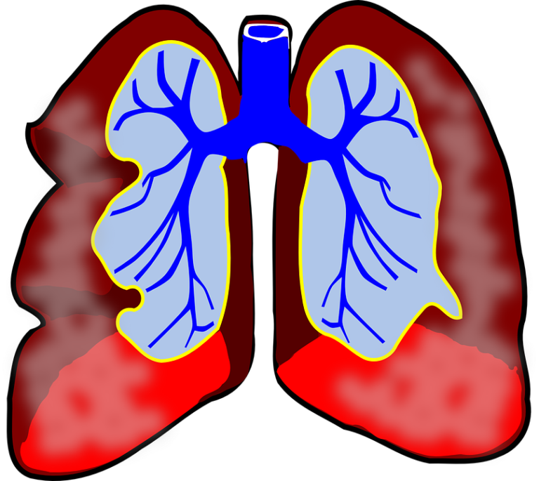 Při dalších onemocněních je porušena schopnost průdušek přivádět vzduch do plicních sklípků. Foto: pixabay