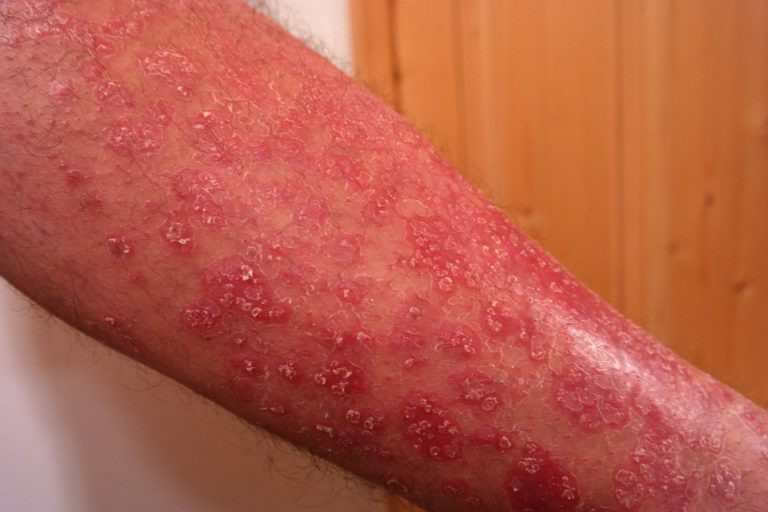 Lupénka (psoriasis vulgaris) patří mezi nejčastější kožní onemocnění u mužů i žen. Vyskytnout se může v jakémkoliv věku. Foto: pixabay