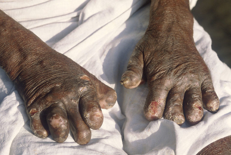 Články prstů postižené leprou. Foto: Creative Commons, B.jehle, CC BY-SA 3.0.