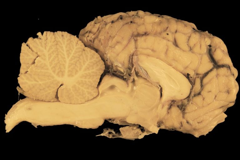 Parkinsonova choroba je neurodegenerativní onemocnění centrální nervové soustavy, které přímo souvisí s úbytkem nervových buněk v části mozku nazvané Substantia nigra. Foto: pixabay