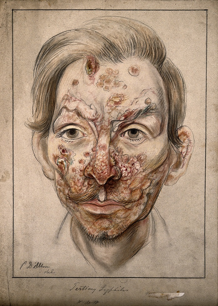 Typické příznaky pokročilé syfilis v obličeji muže. FOTO: https://wellcomeimages.org/indexplus/image/V0009903.html/Creative Commons/CC BY 4.0
