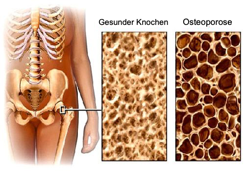 Osteoporóze se někdy říká také tichý zloděj kostí. Foto: Partynia / Creative Commons / CC-BY-SA-4.0