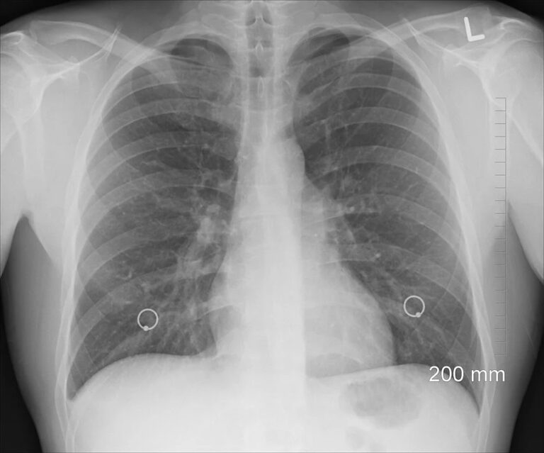 Časnou diagnostiku obou nemocí může zlepšit chystaný národní screening plicní rakoviny. Foto: pixabay
