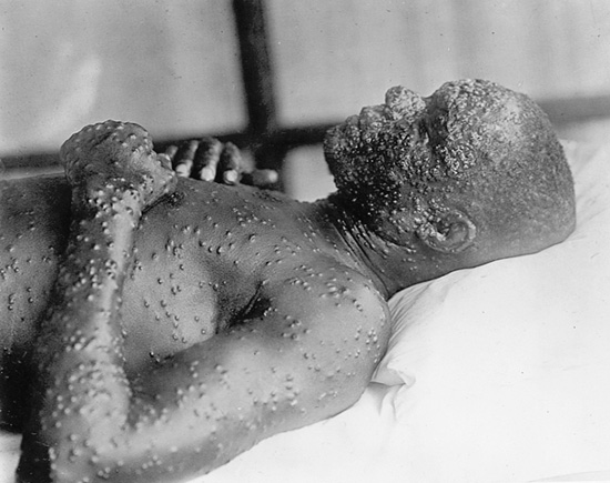 O vymýcení pravých neštovic (na obr.) se zaslouží český vědec Karel Raška. FOTO: Otis Historical Archives Nat'l Museum of Health & Medicine/Creative Commons/CC BY 2.0