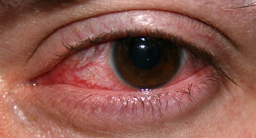 Typické červené oko, které poznalo THC. Foto: Eddie314 at English Wikipedia / CC-AS-3.0