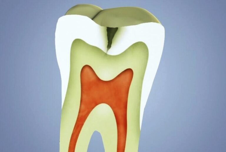 Zubní kaz se se vyskytovat už od pravěku. FOTO: DentalCare/Creative Commons/CC BY 3.0