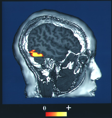 Dlouhá léta se předpokládalo, že onemocnění způsobují těžké úrazy mozku. Foto: Rush University Medical Center